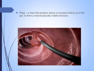  Polyp – a mass that projects above a mucosal surface, as in the
gut, to form a macroscopically visible structure
 