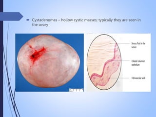  Cystadenomas – hollow cystic masses; typically they are seen in
the ovary
 