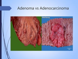 Adenoma vs Adenocarcinoma
 