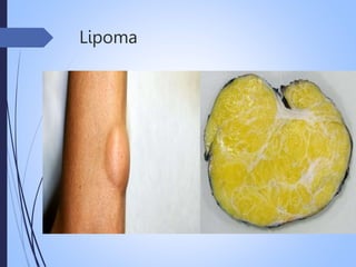Lipoma
 