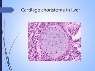 Cartilage choristoma in liver
 