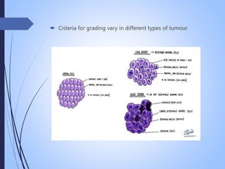  Criteria for grading vary in different types of tumour
 