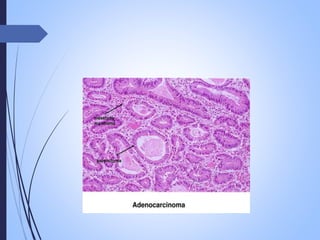 neoplasia , carcinogenesis, tumour market