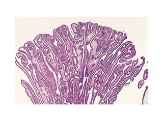 Neoplasia pathology presentation general | PPT