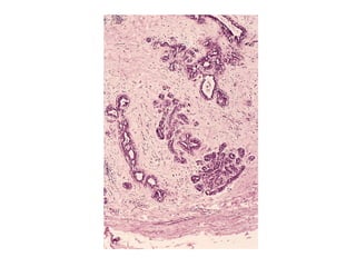 Neoplasia pathology presentation general | PPT