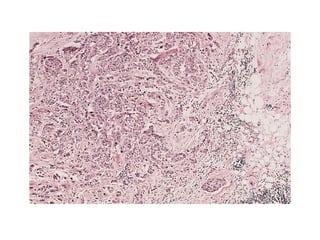 Neoplasia pathology presentation general | PPT
