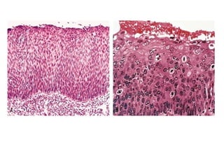 Neoplasia pathology presentation general | PPT