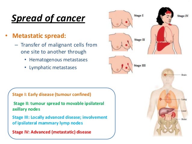4 Carcinomas That Spread Hematogenously