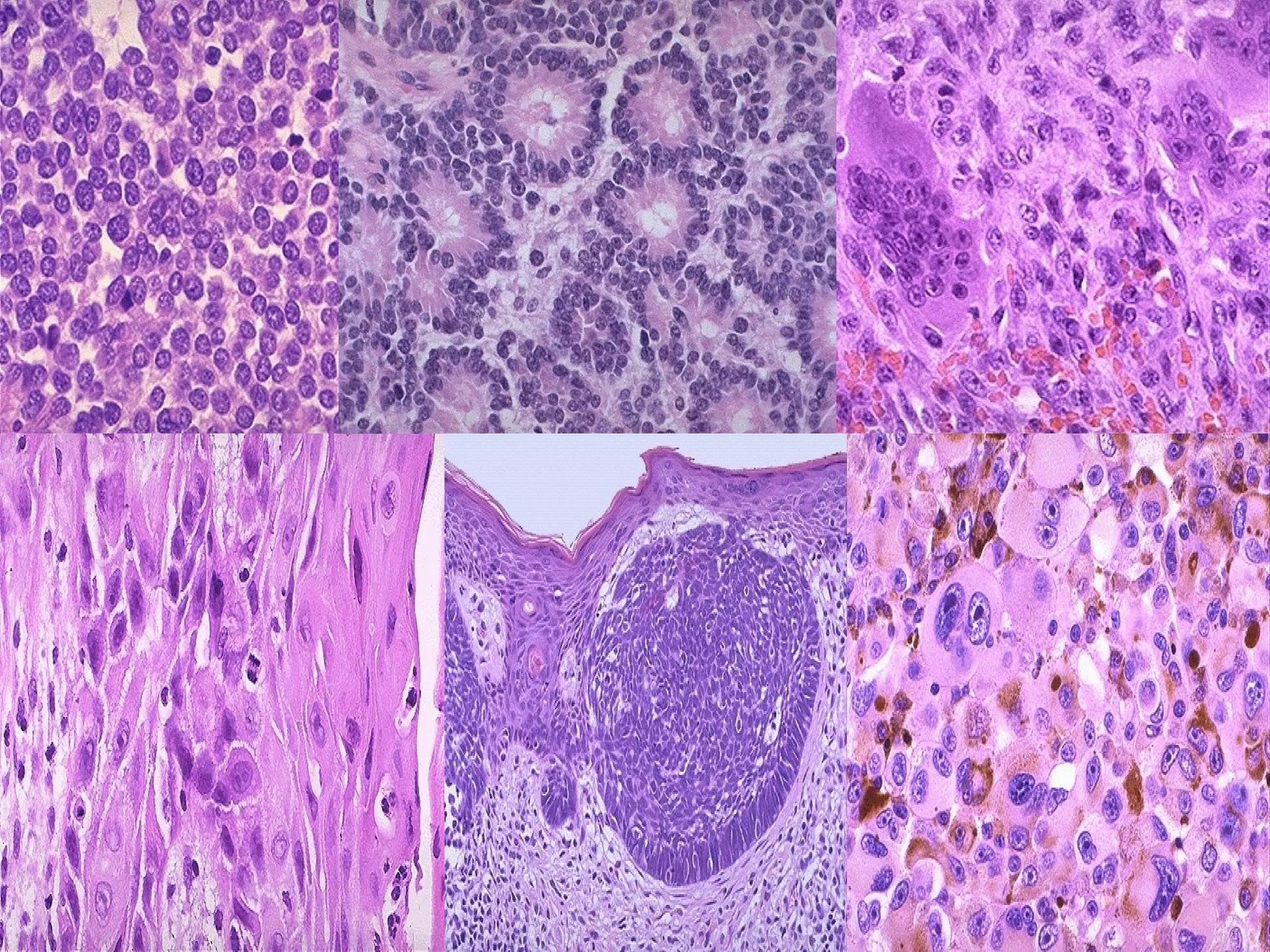 Neoplasia Classification Ppt