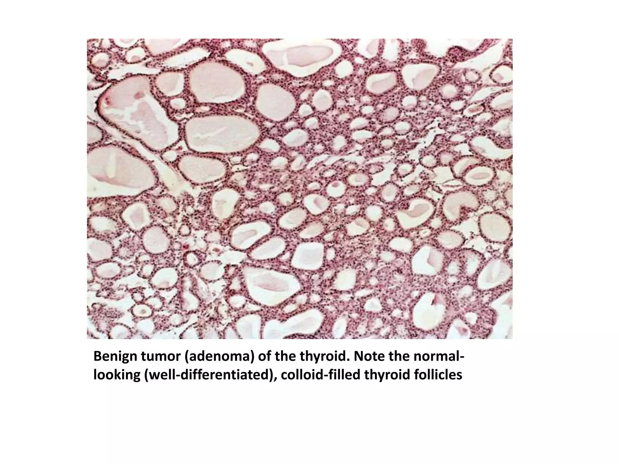 Benign tumor (adenoma) of the thyroid. Note the normal-
looking (well-differentiated), colloid-filled thyroid follicles
 
