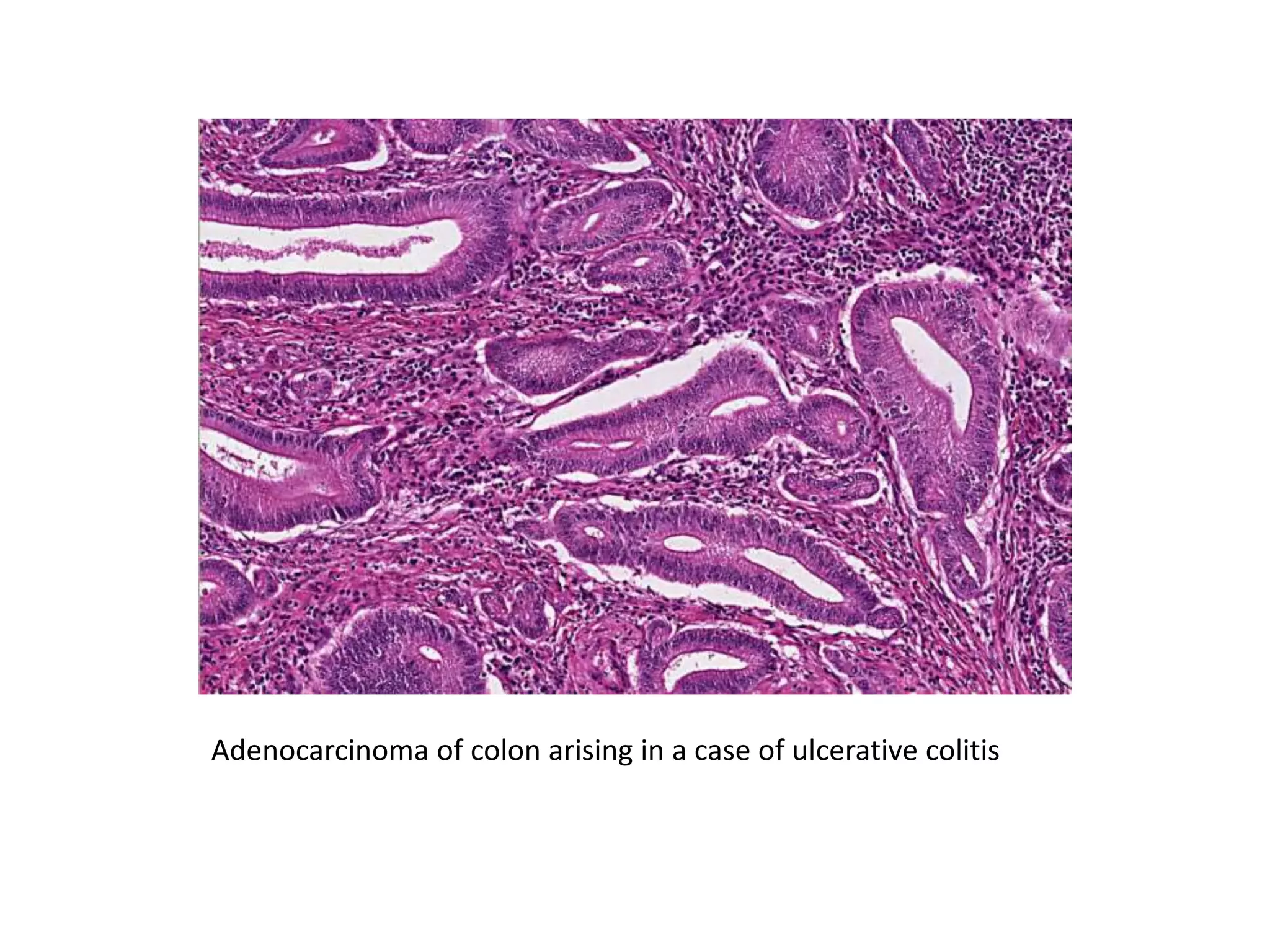 Adenocarcinoma of colon arising in a case of ulcerative colitis
 