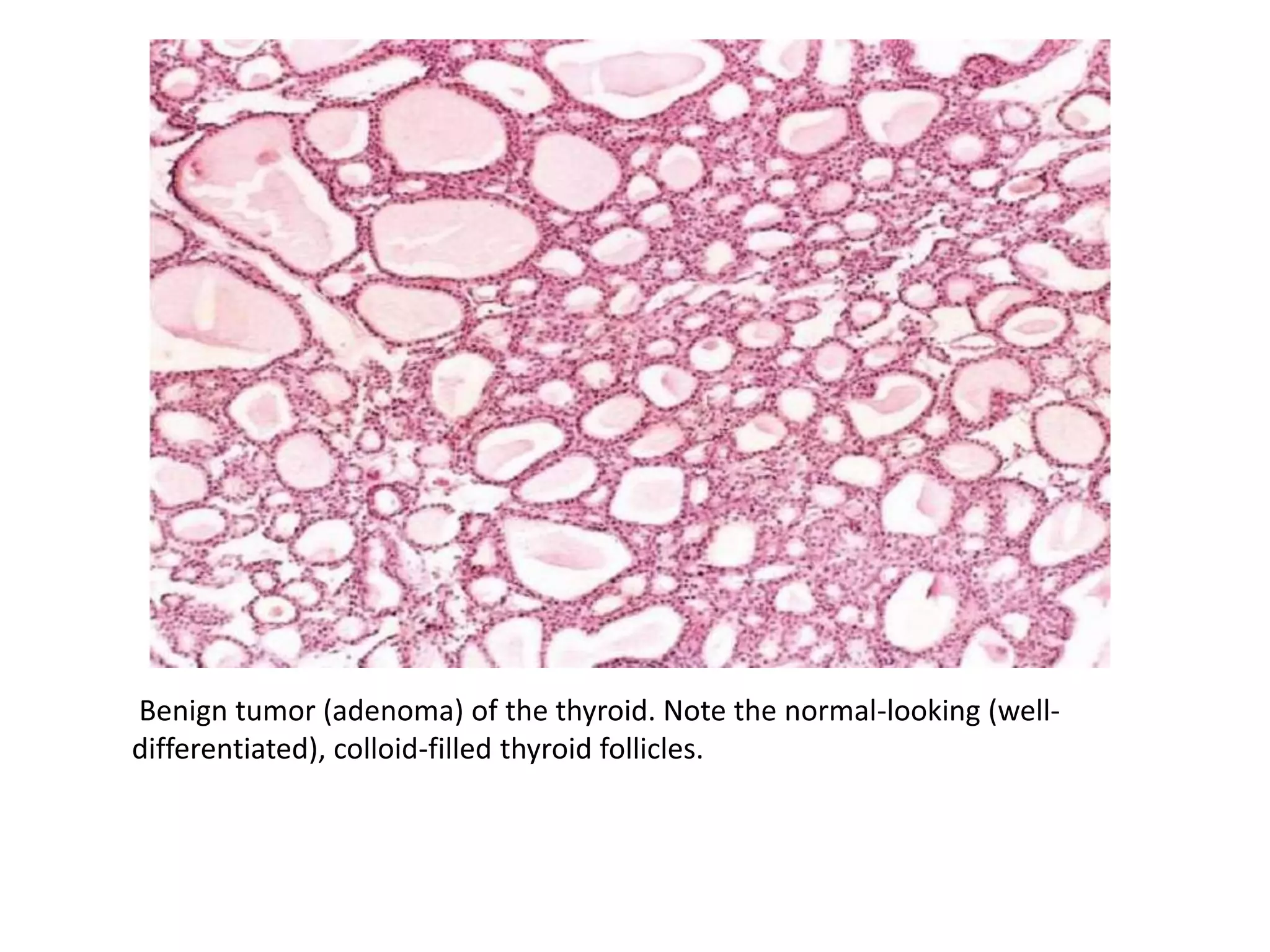 Benign tumor (adenoma) of the thyroid. Note the normal-looking (well-
differentiated), colloid-filled thyroid follicles.
 