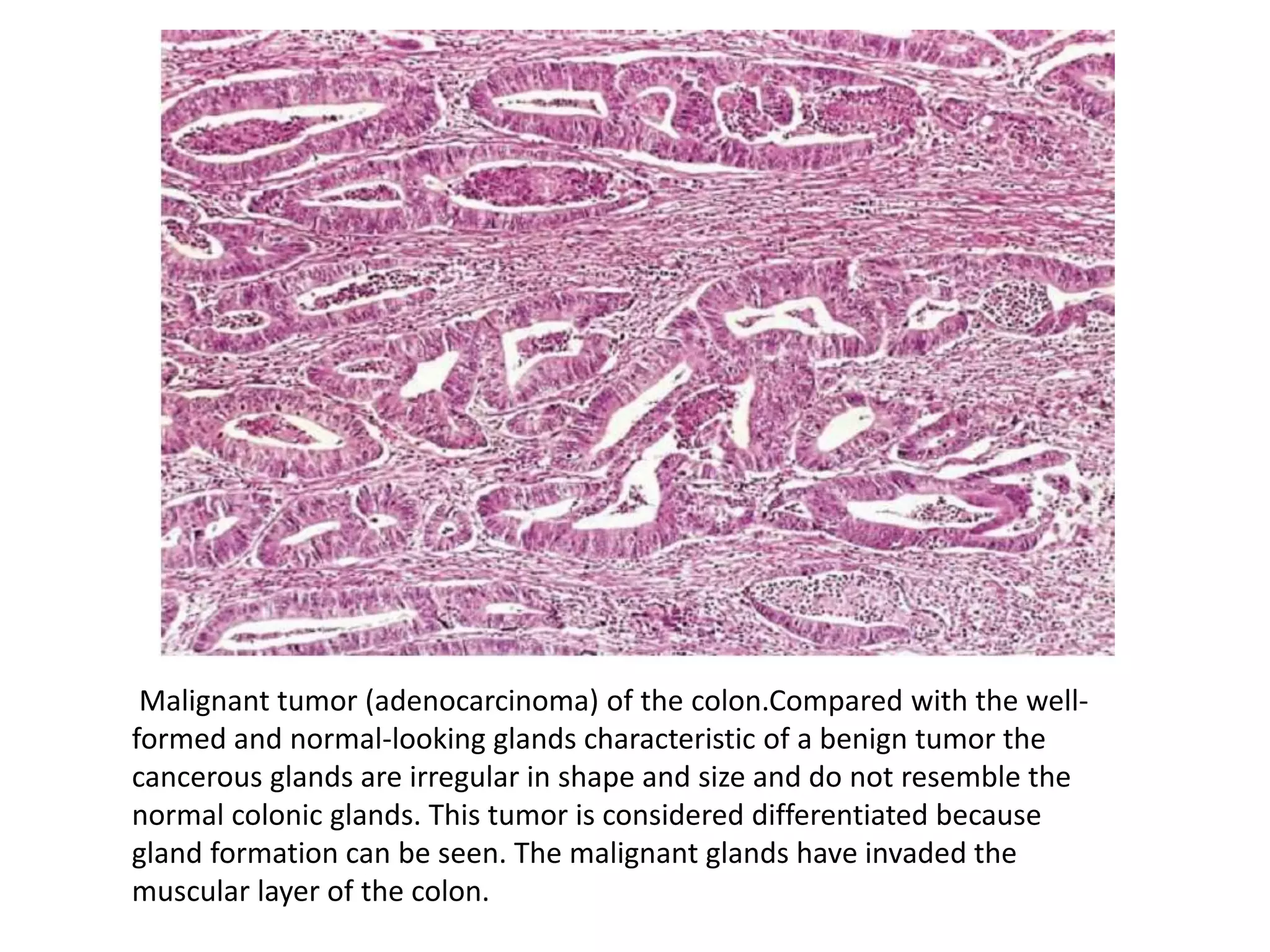 Malignant tumor (adenocarcinoma) of the colon.Compared with the well-
formed and normal-looking glands characteristic of a benign tumor the
cancerous glands are irregular in shape and size and do not resemble the
normal colonic glands. This tumor is considered differentiated because
gland formation can be seen. The malignant glands have invaded the
muscular layer of the colon.
 