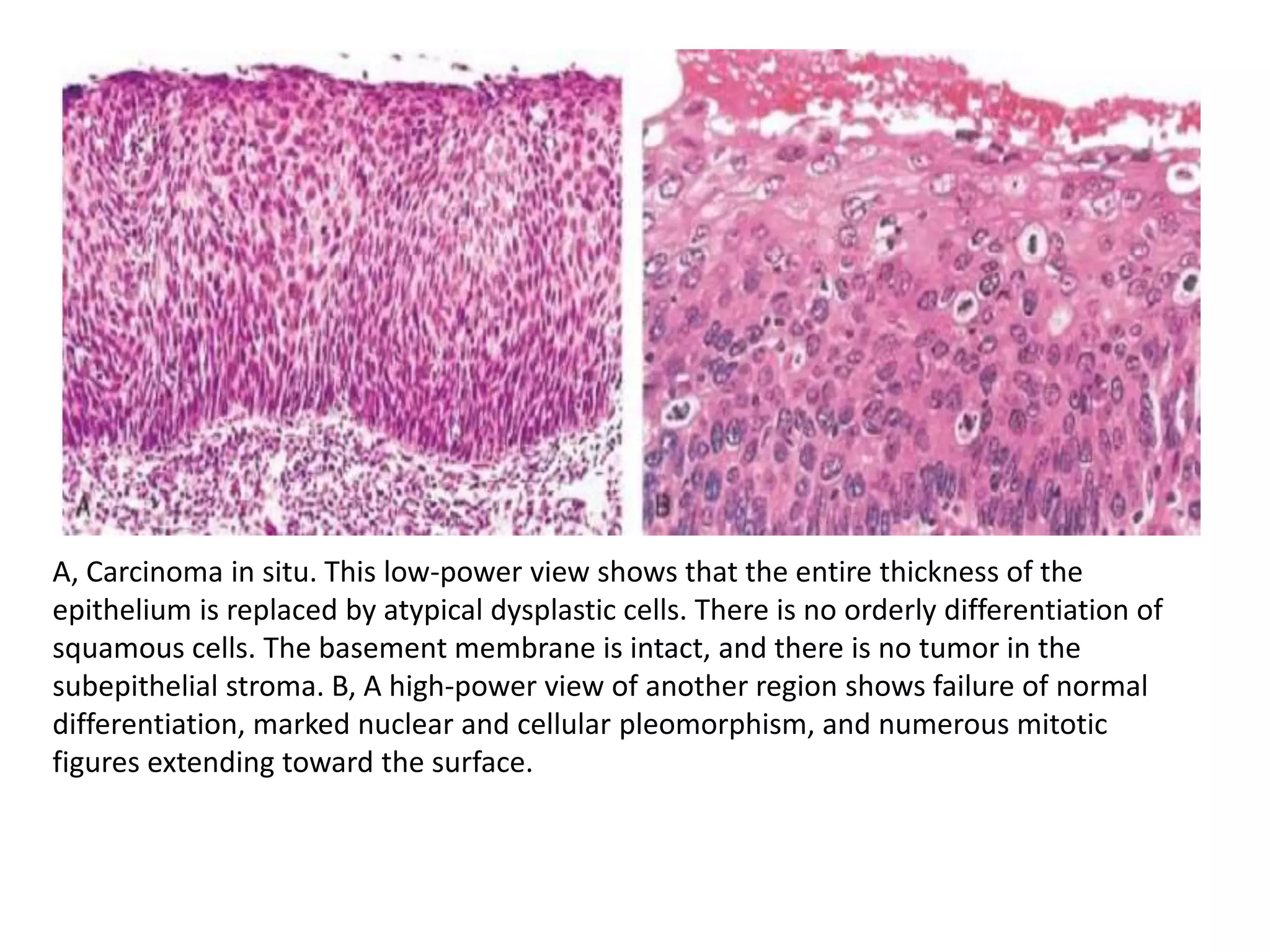 A, Carcinoma in situ. This low-power view shows that the entire thickness of the
epithelium is replaced by atypical dysplastic cells. There is no orderly differentiation of
squamous cells. The basement membrane is intact, and there is no tumor in the
subepithelial stroma. B, A high-power view of another region shows failure of normal
differentiation, marked nuclear and cellular pleomorphism, and numerous mitotic
figures extending toward the surface.
 