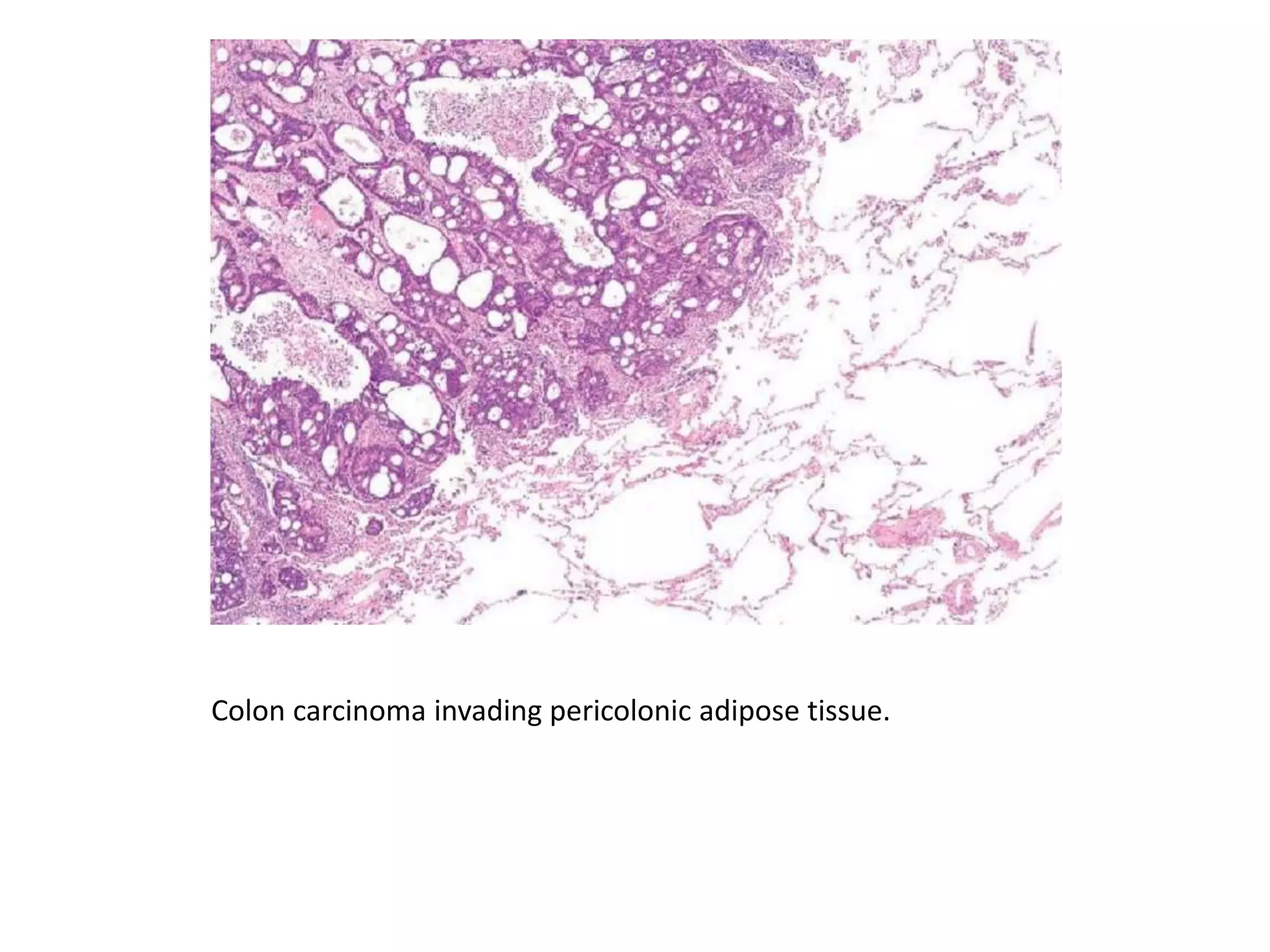 Colon carcinoma invading pericolonic adipose tissue.
 