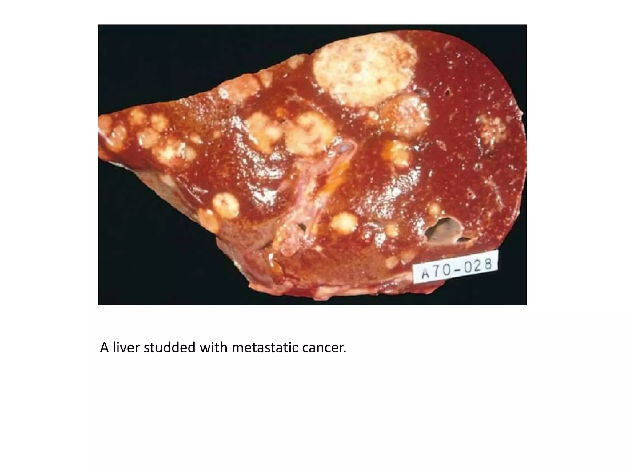 A liver studded with metastatic cancer.
 
