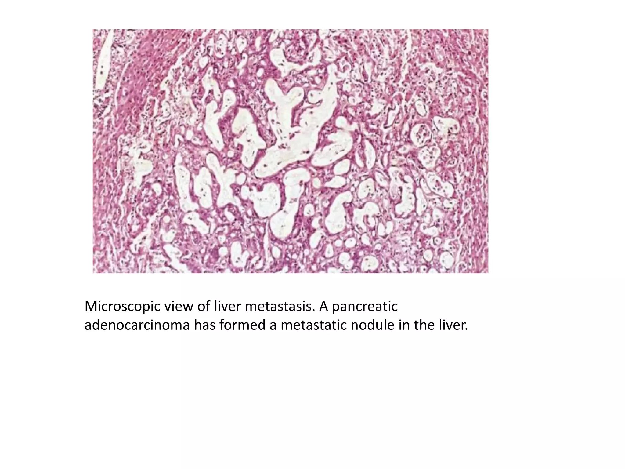 Microscopic view of liver metastasis. A pancreatic
adenocarcinoma has formed a metastatic nodule in the liver.
 