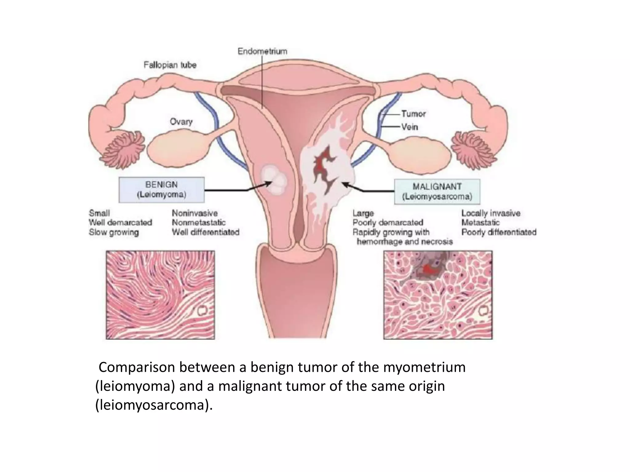 Comparison between a benign tumor of the myometrium
(leiomyoma) and a malignant tumor of the same origin
(leiomyosarcoma).
 
