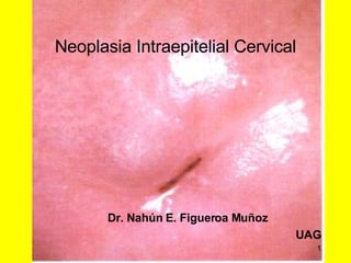 Neoplasia Intraepitelial Cervical ,[object Object],[object Object],[object Object]