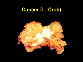 Cancer (L. Crab)
 