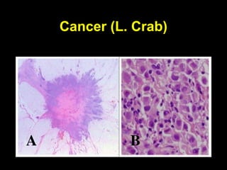 Cancer (L. Crab)
 