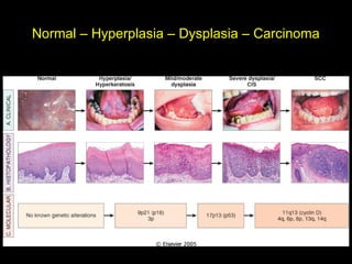 Normal – Hyperplasia – Dysplasia – Carcinoma
 