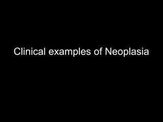 Clinical examples of Neoplasia
 