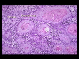 ParenchymaParenchyma
StromaStroma
 