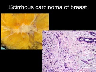 Scirrhous carcinoma of breast
 