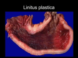 Linitus plastica
 