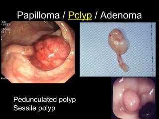 Papilloma / Polyp / Adenoma
Pedunculated polyp
Sessile polyp
 
