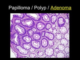 Papilloma / Polyp / Adenoma
 