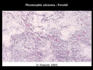 Pleomorphic adenoma - Parotid
 