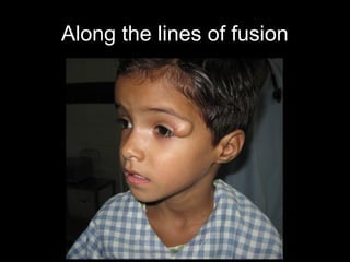 Along the lines of fusion
 