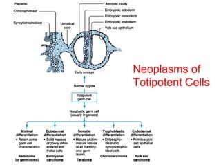 Neoplasms of
Totipotent Cells
 