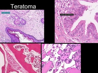 Teratoma
 