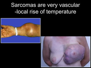 Sarcomas are very vascular
-local rise of temperature
 