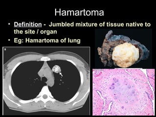 Hamartoma
• Definition - Jumbled mixture of tissue native to
the site / organ
• Eg: Hamartoma of lung
 