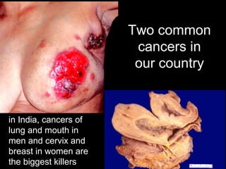 Two common
cancers in
our country
in India, cancers of
lung and mouth in
men and cervix and
breast in women are
the biggest killers
 