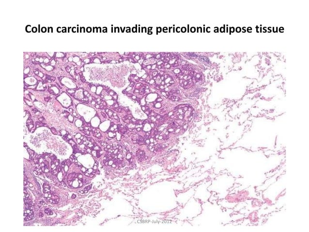 Neoplasia Robbin's path | PPTX