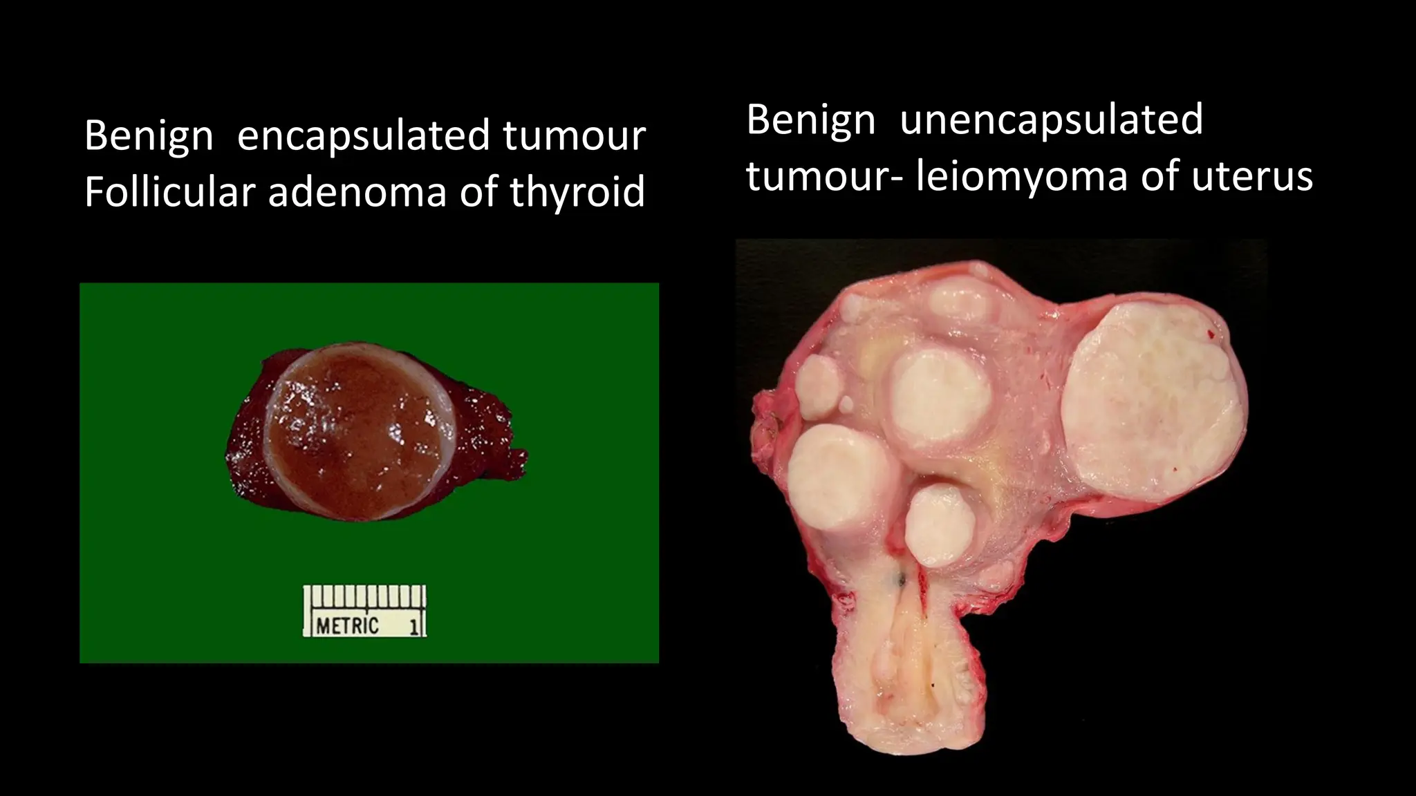 Neoplasia - Benign and malignant tumours nomenclature and difference.pdf