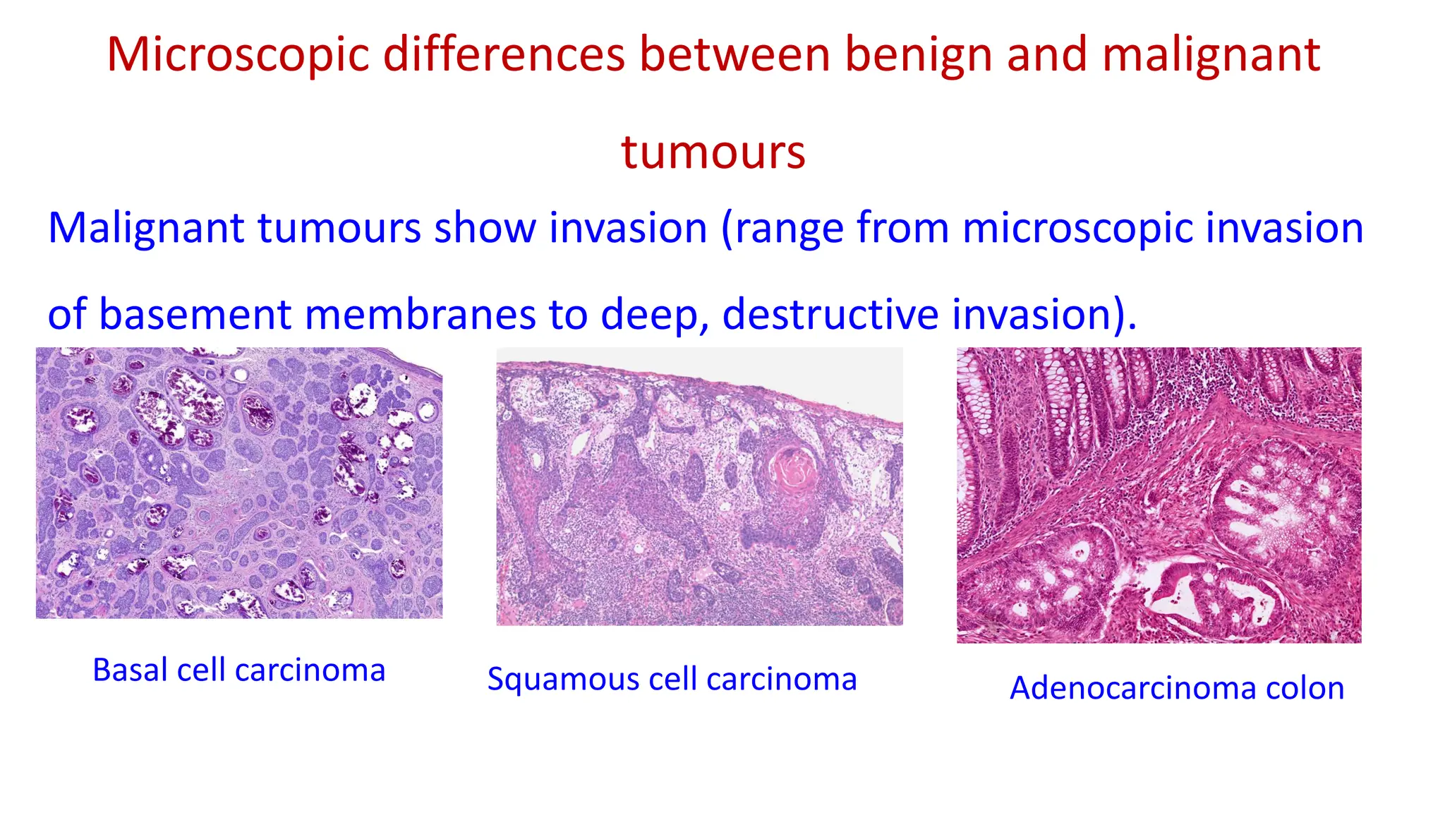 Neoplasia - Benign and malignant tumours nomenclature and difference.pdf