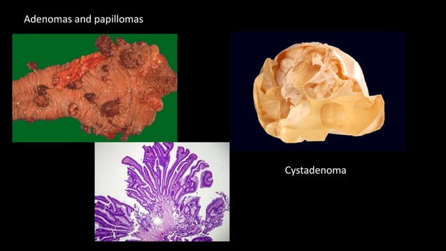 Neoplasia Benign And Malignant Tumours Nomenclature And Difference Pdf