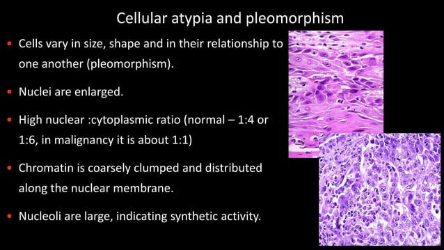 Neoplasia Benign And Malignant Tumours Nomenclature And Difference Pdf