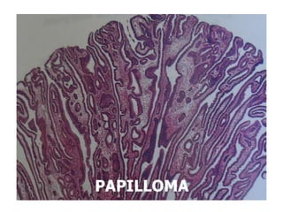 PAPILLOMA
 