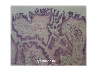cystadenoma
 
