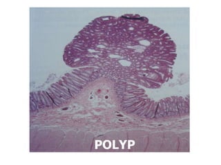POLYP
 