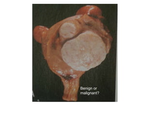 Benign or
malignant?
 