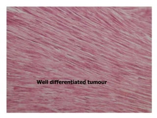 Well differentiated tumour
 