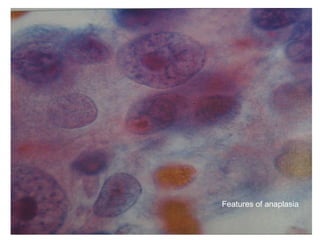 Features of anaplasia
 